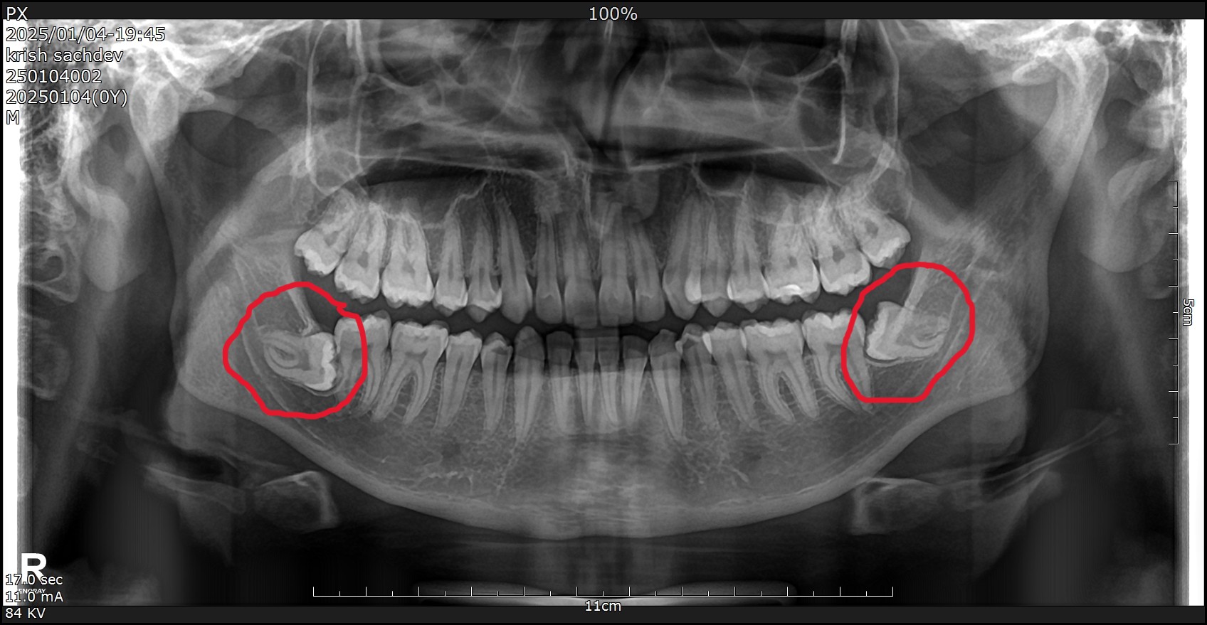 Wisdom Teeth Problems